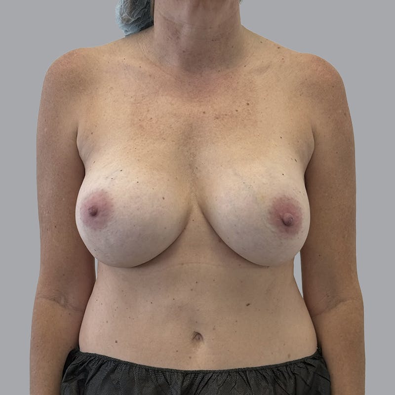 Breast Implant Removal Before & After Gallery - Patient 354931 - Image 1