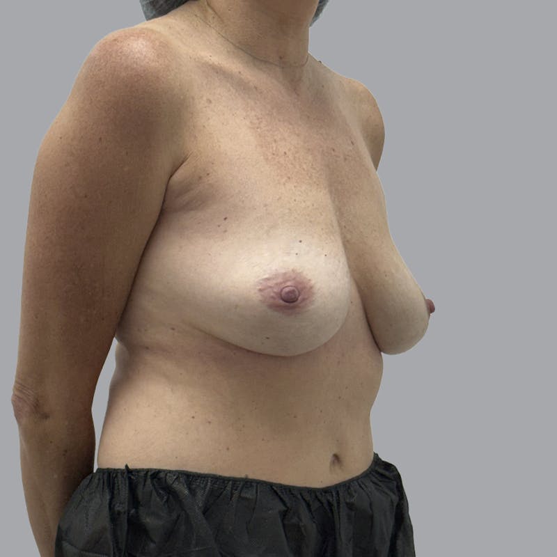 Breast Implant Removal Before & After Gallery - Patient 354931 - Image 4