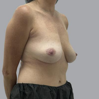 Breast Implant Removal Before & After Gallery - Patient 354931 - Image 4