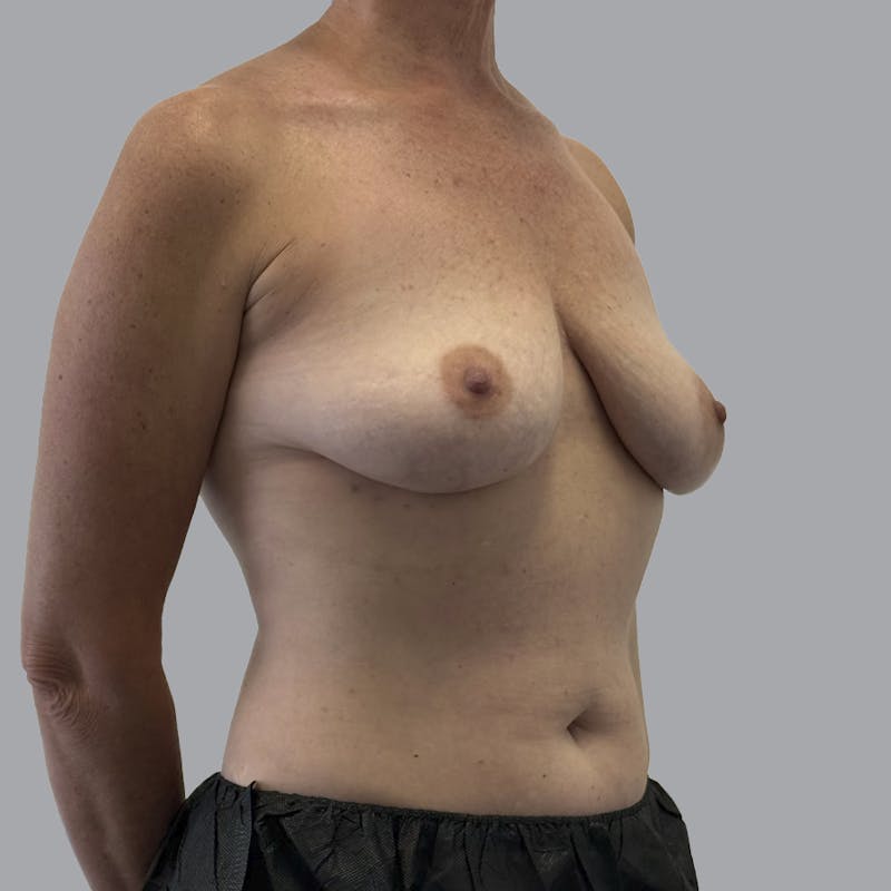 Breast Implant Removal Before & After Gallery - Patient 250703 - Image 4