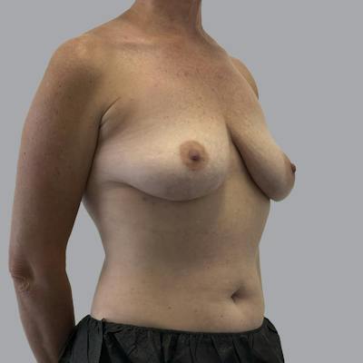 Breast Implant Removal Before & After Gallery - Patient 250703 - Image 4