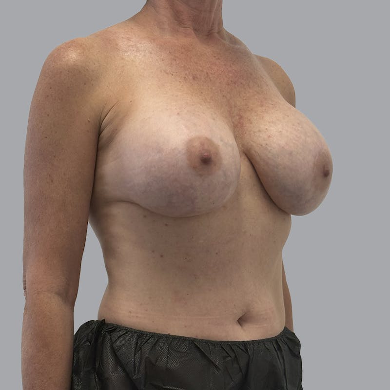 Breast Implant Removal Before & After Gallery - Patient 250703 - Image 3