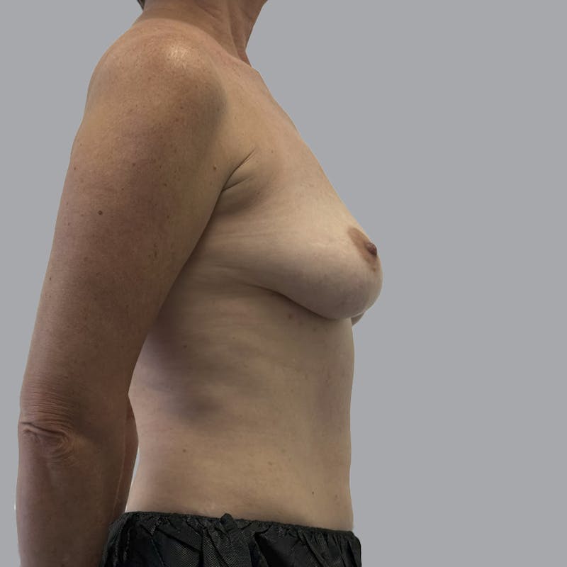 Breast Implant Removal Before & After Gallery - Patient 250703 - Image 6