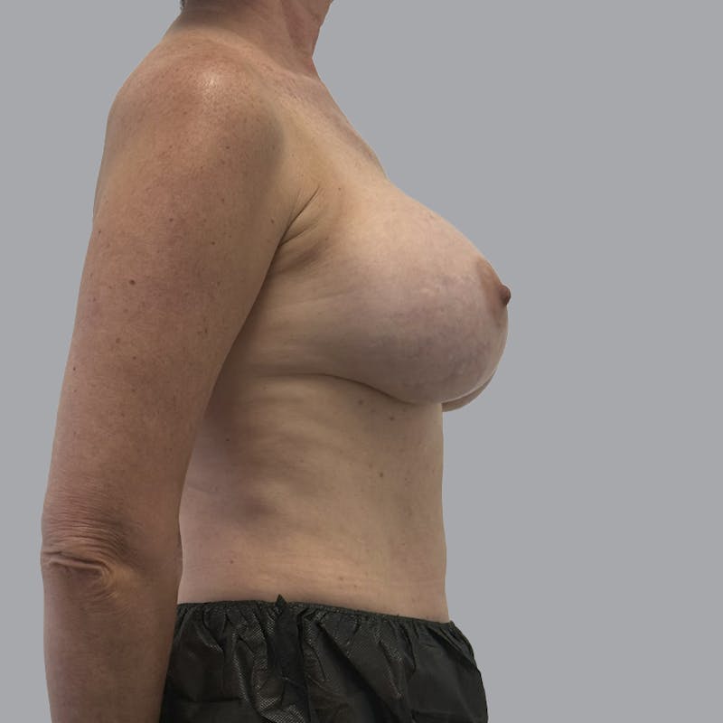 Breast Implant Removal Before & After Gallery - Patient 250703 - Image 5