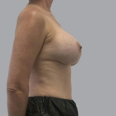 Breast Implant Removal Before & After Gallery - Patient 250703 - Image 5