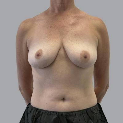 Breast Implant Removal Before & After Gallery - Patient 250703 - Image 2