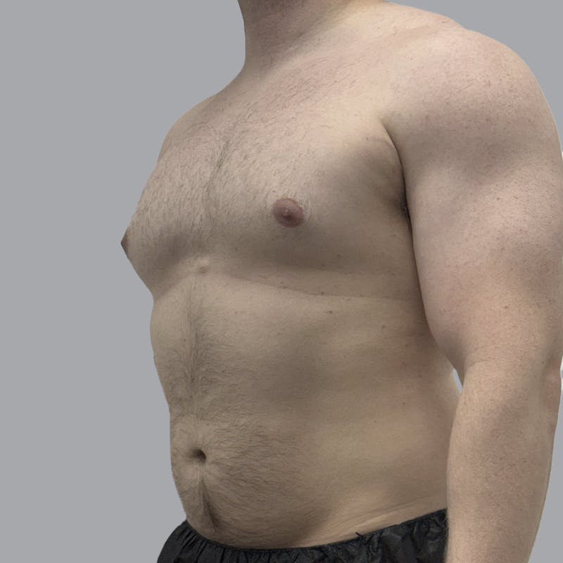 Gynecomastia Before & After Gallery - Patient 315901 - Image 3