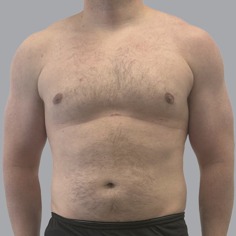 Gynecomastia Before & After Gallery - Patient 315901 - Image 2