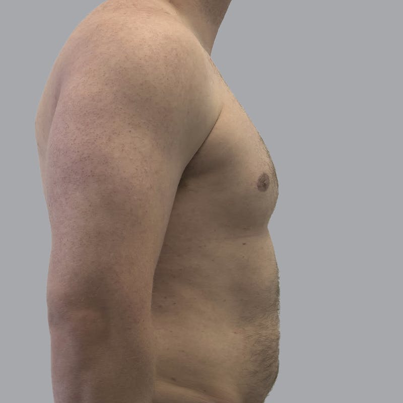 Gynecomastia Before & After Gallery - Patient 315901 - Image 6
