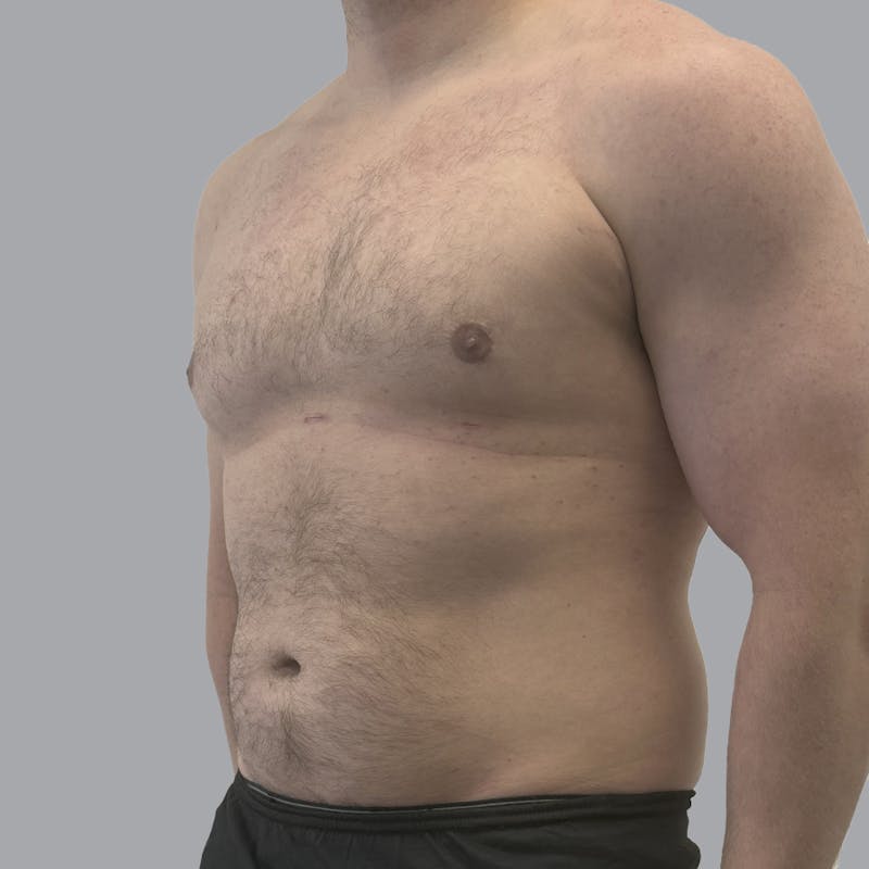 Gynecomastia Before & After Gallery - Patient 315901 - Image 4