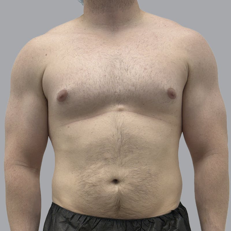 Gynecomastia Before & After Gallery - Patient 315901 - Image 1