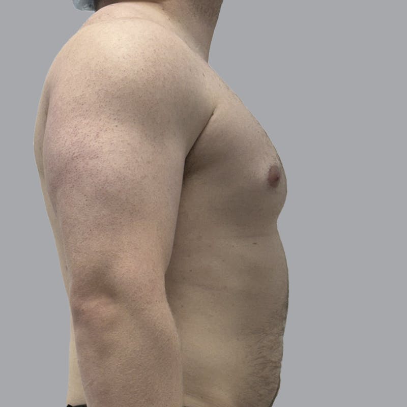 Gynecomastia Before & After Gallery - Patient 315901 - Image 5