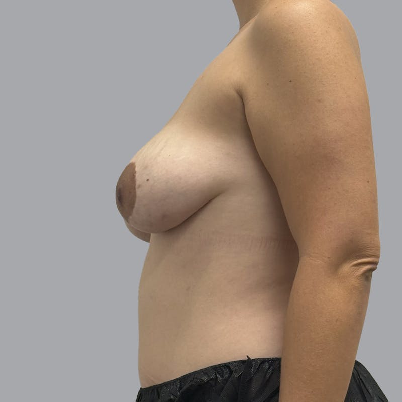 Breast Implant Removal Before & After Gallery - Patient 165025 - Image 6