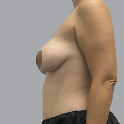 Breast Implant Removal Before & After Gallery - Patient 165025 - Image 6
