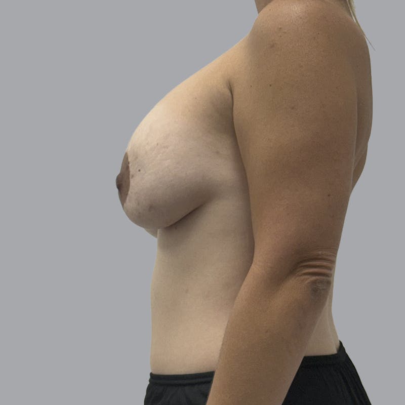 Breast Implant Removal Before & After Gallery - Patient 165025 - Image 5