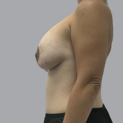 Breast Implant Removal Before & After Gallery - Patient 165025 - Image 5