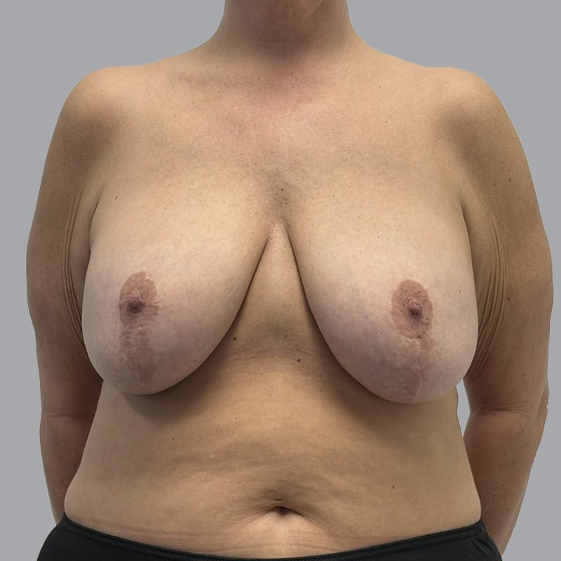 Breast Implant Removal Before & After Gallery - Patient 284439 - Image 1