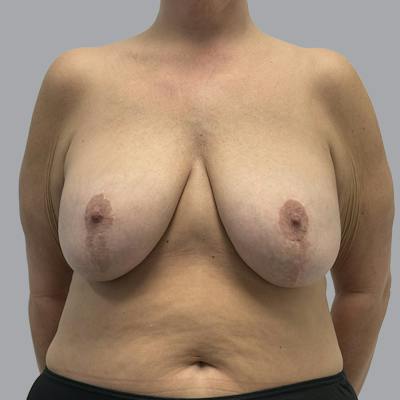 Breast Implant Removal Before & After Gallery - Patient 284439 - Image 1