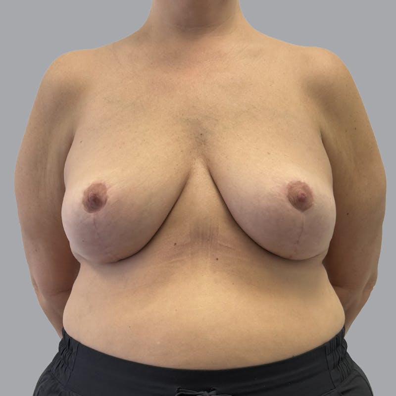 Breast Implant Removal Before & After Gallery - Patient 284439 - Image 2