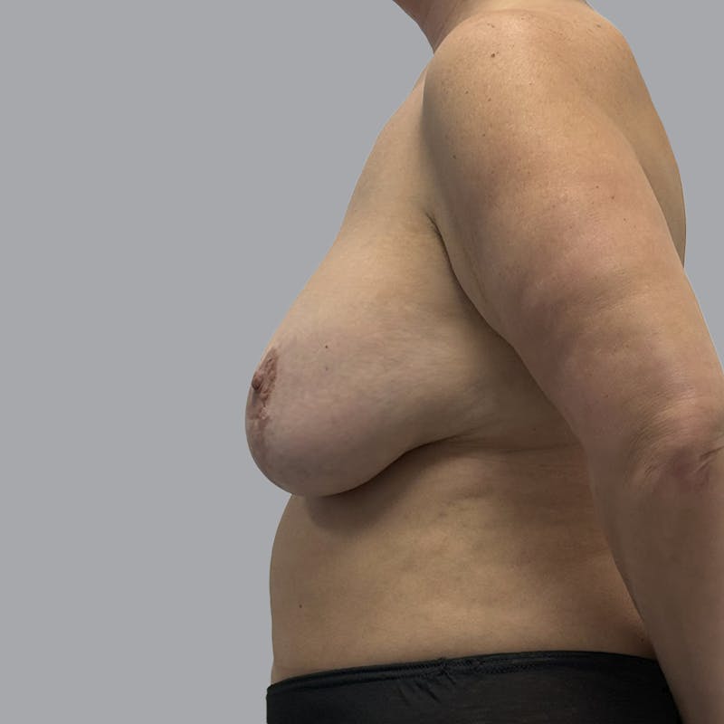 Breast Implant Removal Before & After Gallery - Patient 284439 - Image 5