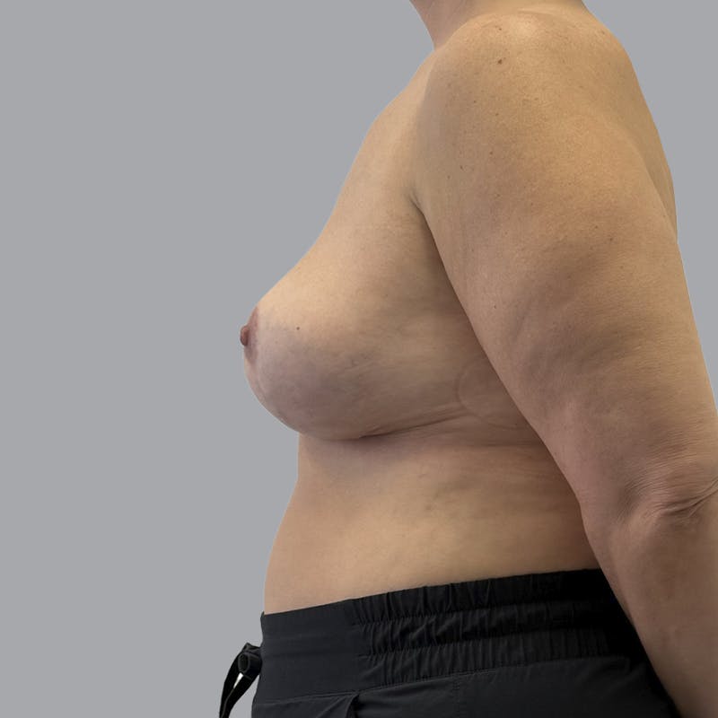 Breast Implant Removal Before & After Gallery - Patient 284439 - Image 6