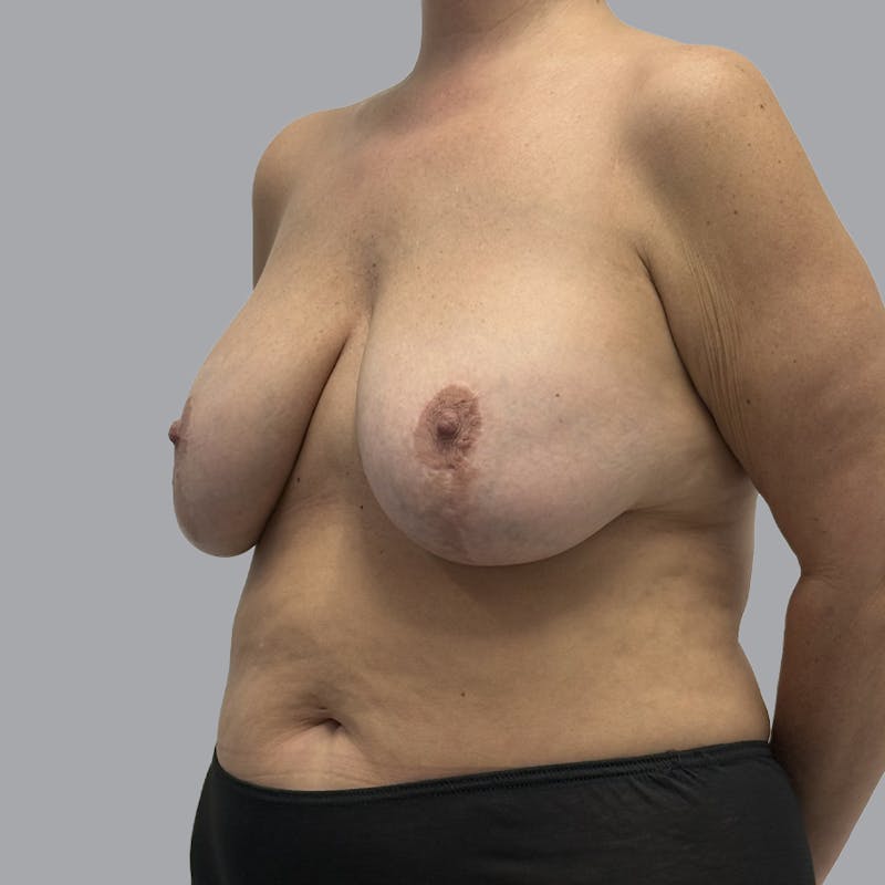 Breast Implant Removal Before & After Gallery - Patient 284439 - Image 3
