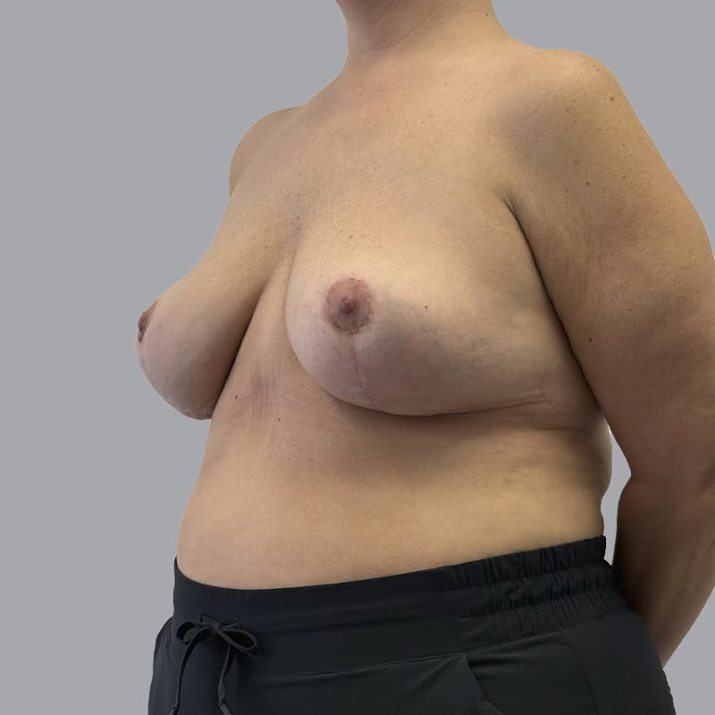 Breast Implant Removal Before & After Gallery - Patient 284439 - Image 4
