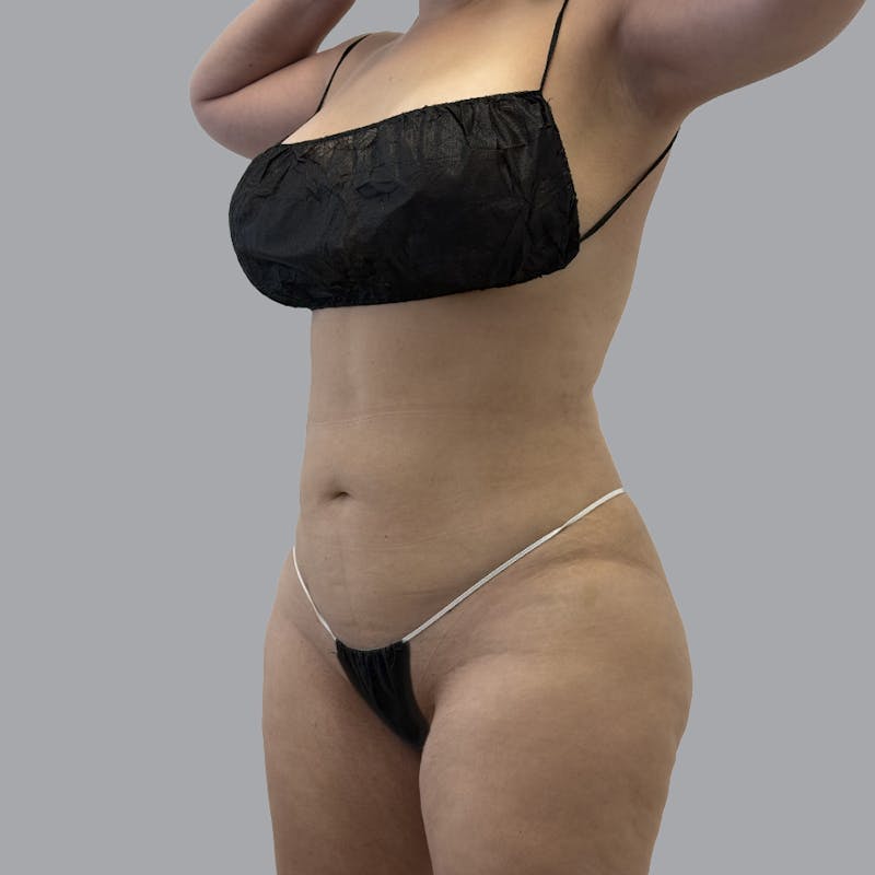 Body Liposuction Before & After Gallery - Patient 139067 - Image 4