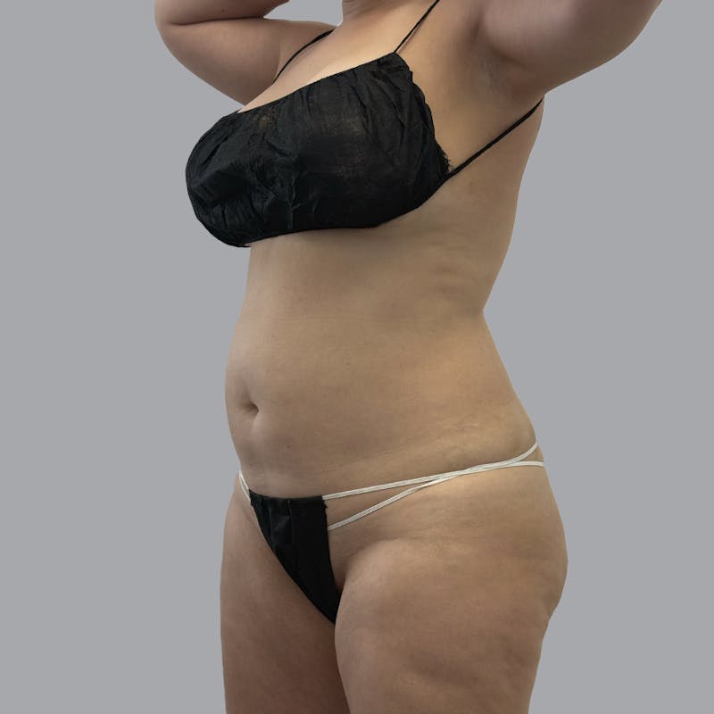 Body Liposuction Before & After Gallery - Patient 139067 - Image 3