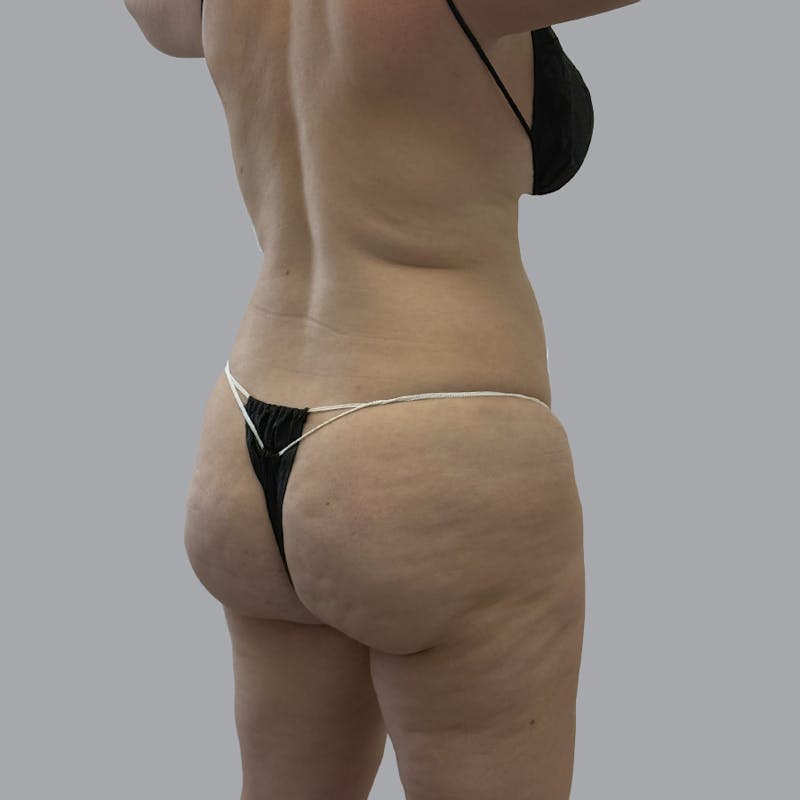 Body Liposuction Before & After Gallery - Patient 139067 - Image 7