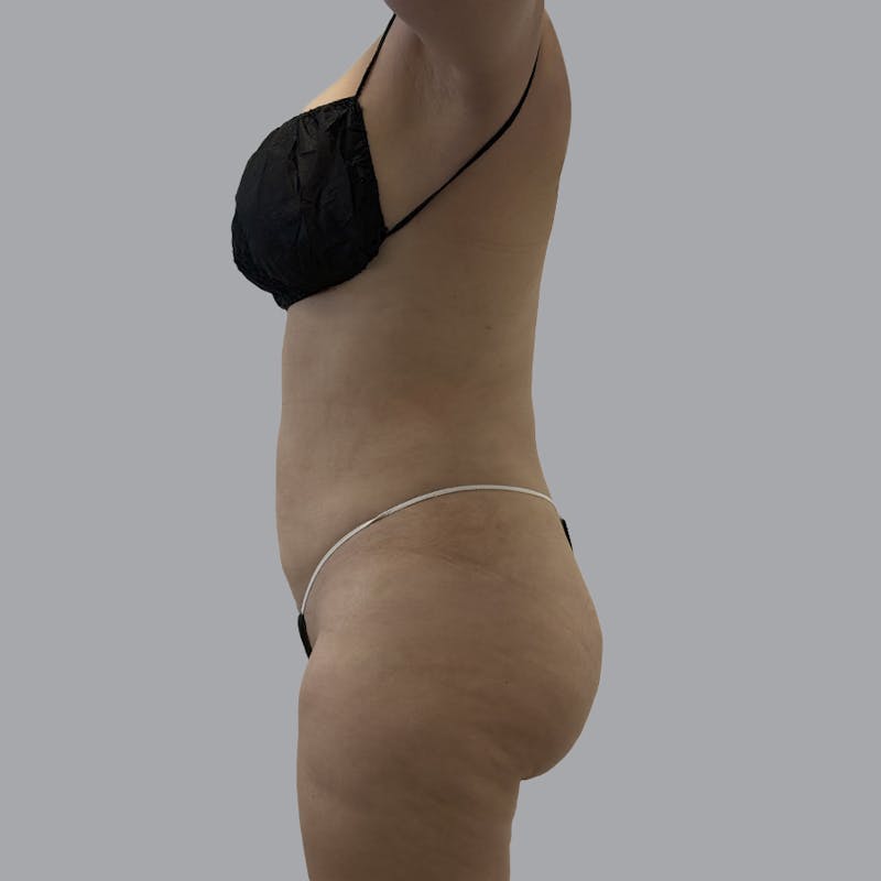 Body Liposuction Before & After Gallery - Patient 139067 - Image 6