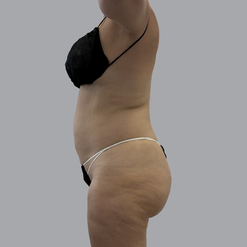 Body Liposuction Before & After Gallery - Patient 139067 - Image 5