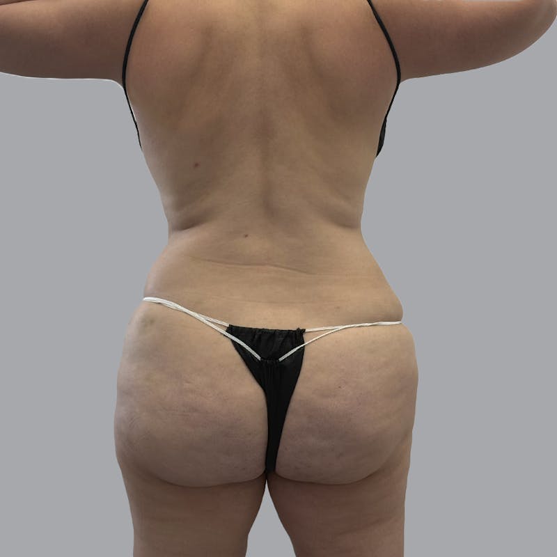 Body Liposuction Before & After Gallery - Patient 139067 - Image 9