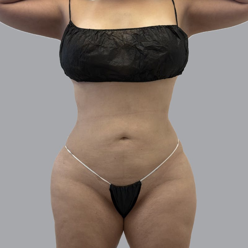 Body Liposuction Before & After Gallery - Patient 139067 - Image 2
