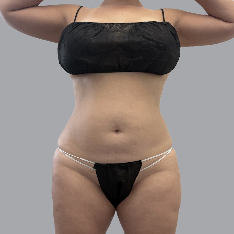 Body Liposuction Before & After Gallery - Patient 139067 - Image 1