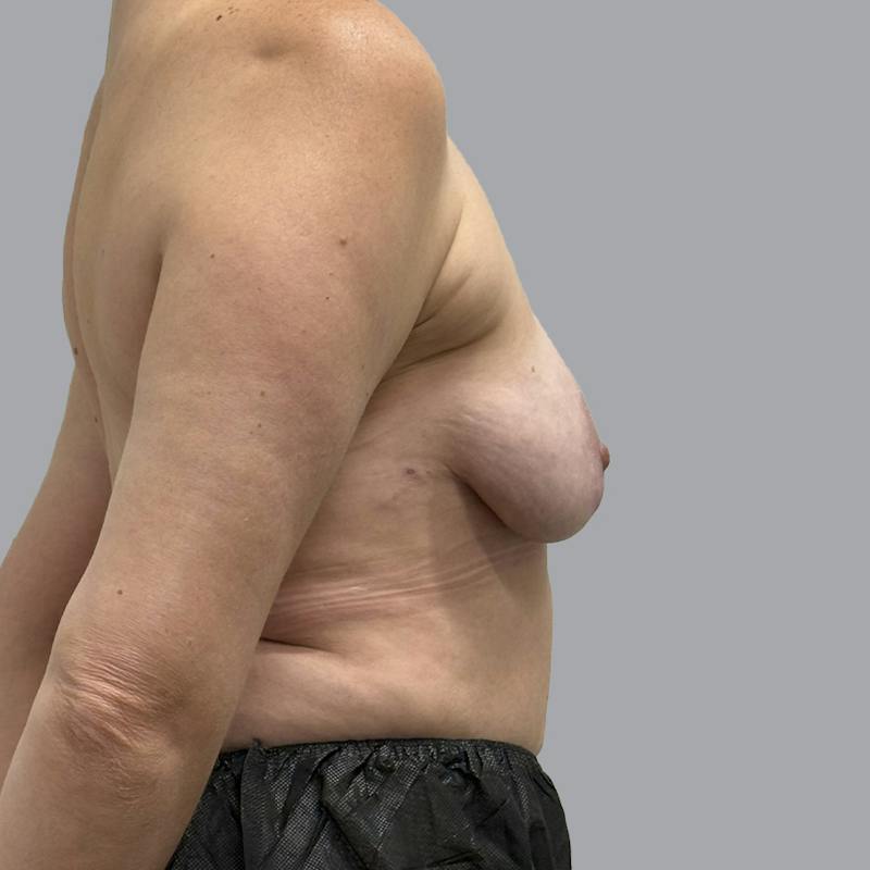 Breast Implant Removal Before & After Gallery - Patient 161595 - Image 6