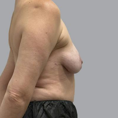 Breast Implant Removal Before & After Gallery - Patient 161595 - Image 6