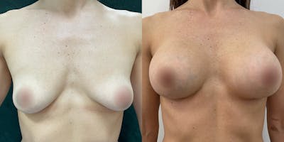 Breast Augmentation Before & After Gallery - Patient 55793688 - Image 1