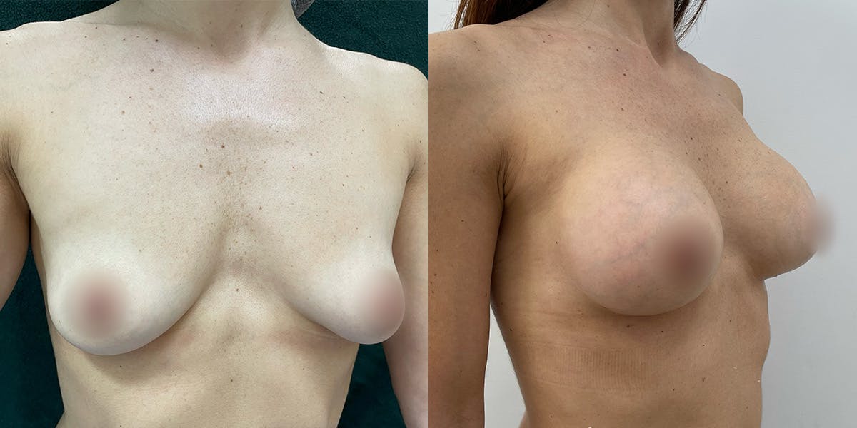 Breast Augmentation Before & After Gallery - Patient 55793688 - Image 2