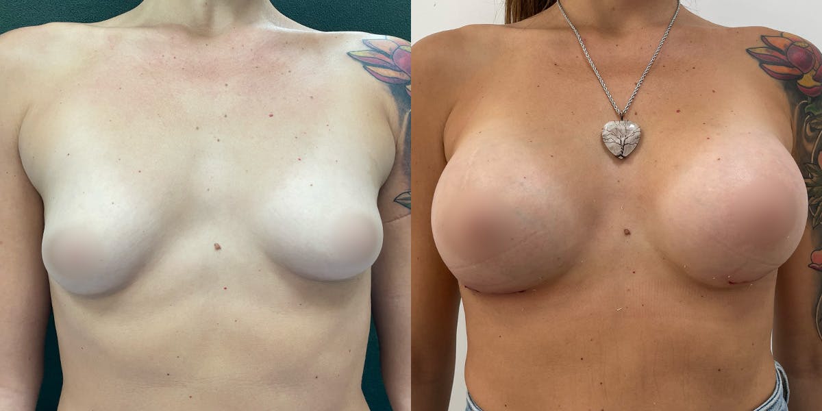 Breast Augmentation Before & After Gallery - Patient 55793687 - Image 1