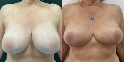 Breast Reduction Before & After Gallery - Patient 55793689 - Image 1