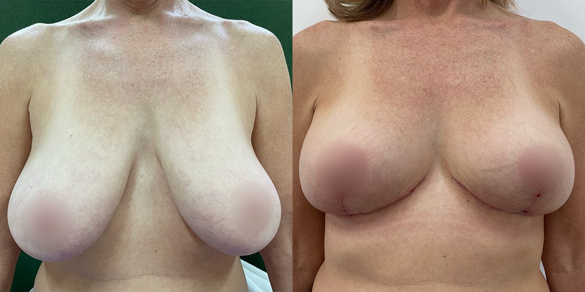 Breast Reduction Before & After Gallery - Patient 55793692 - Image 1