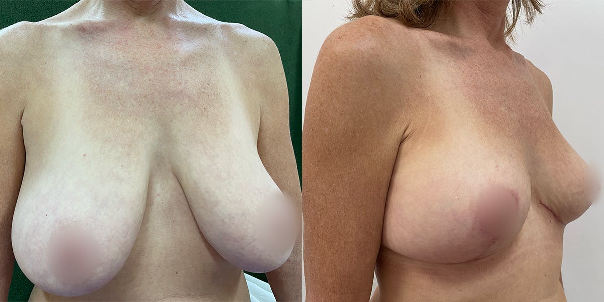 Breast Reduction Before & After Gallery - Patient 55793692 - Image 2
