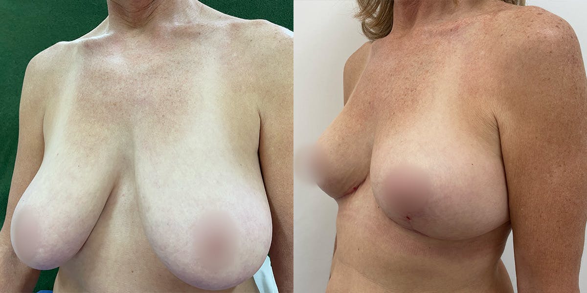 Breast Reduction Before & After Gallery - Patient 55793692 - Image 3