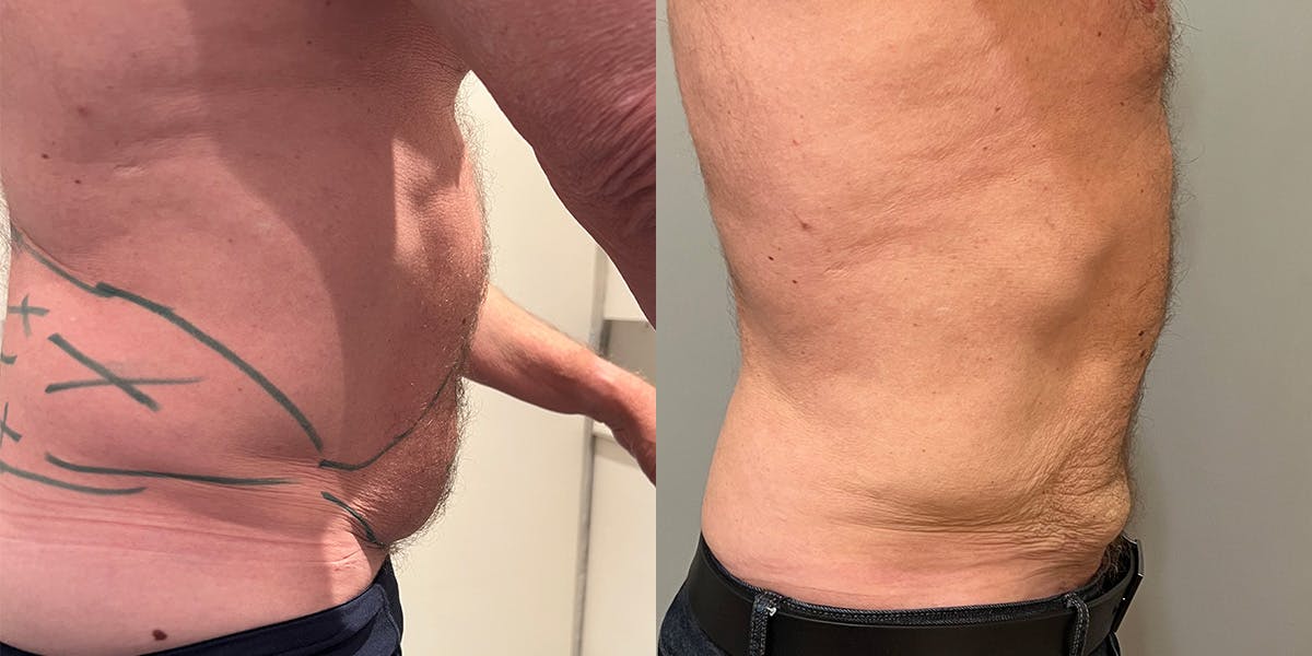 Liposuction Before & After Gallery - Patient 55793693 - Image 2