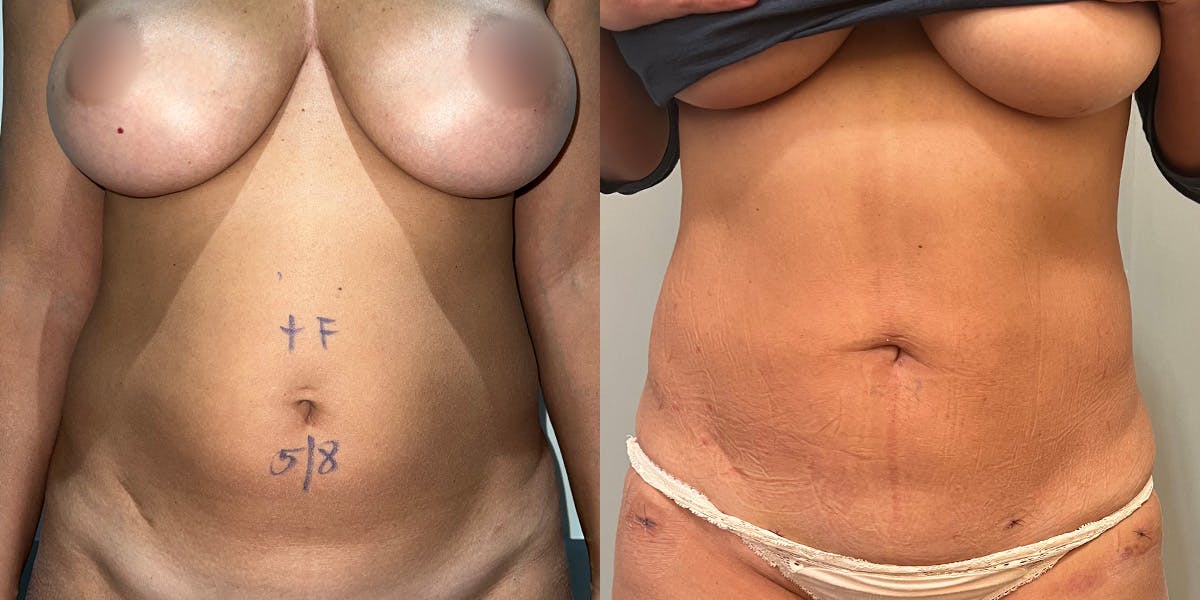 Liposuction Before & After Gallery - Patient 55793694 - Image 1