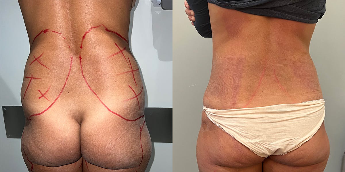 Liposuction Before & After Gallery - Patient 55793694 - Image 3