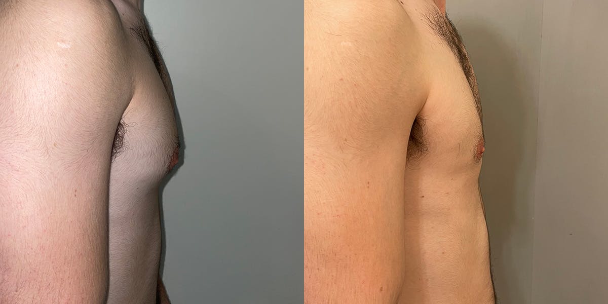 Gynecomastia Before & After Gallery - Patient 55793695 - Image 2