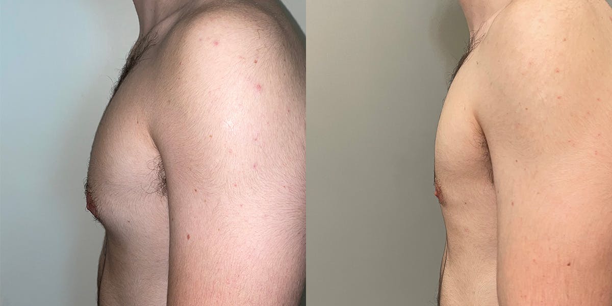Gynecomastia Before & After Gallery - Patient 55793695 - Image 3