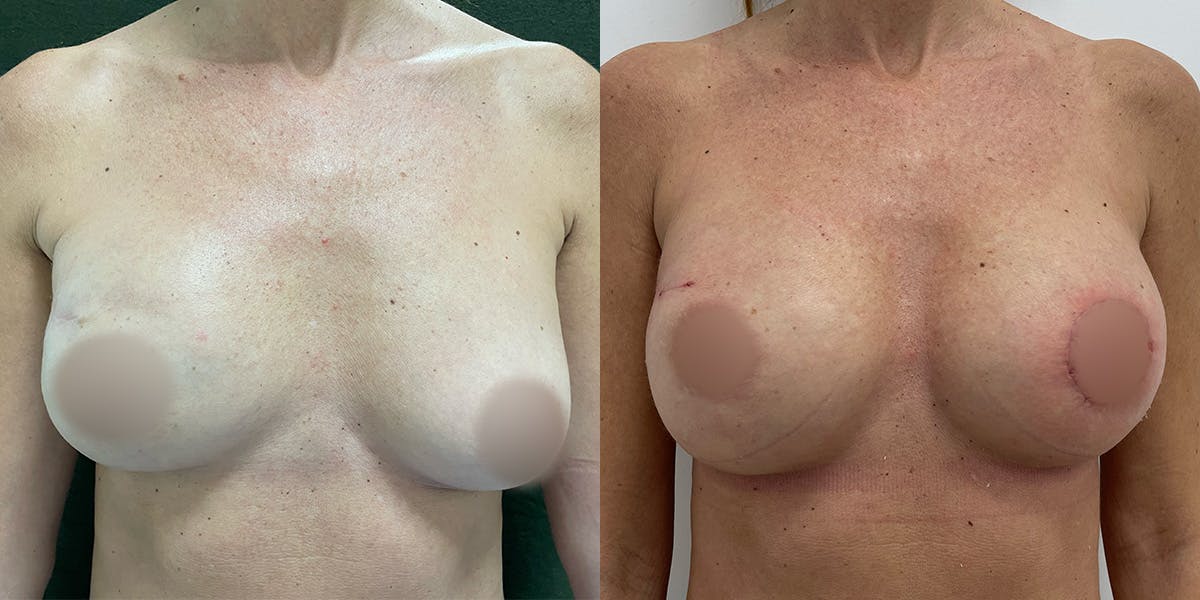 Breast Reconstruction Before & After Gallery - Patient 55793697 - Image 1